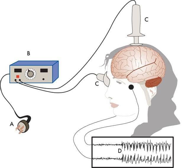 Image result for Electroconvulsive Therapy